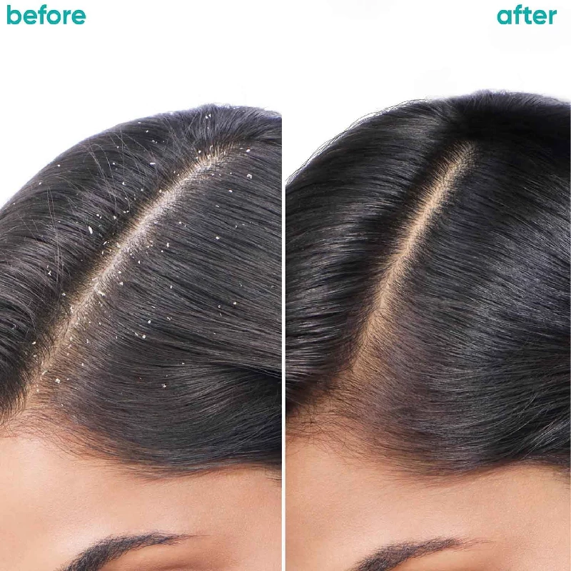 Biolage Professional Scalppure Anti-Dandruff Shampoo and Conditioner Combo - Image 2